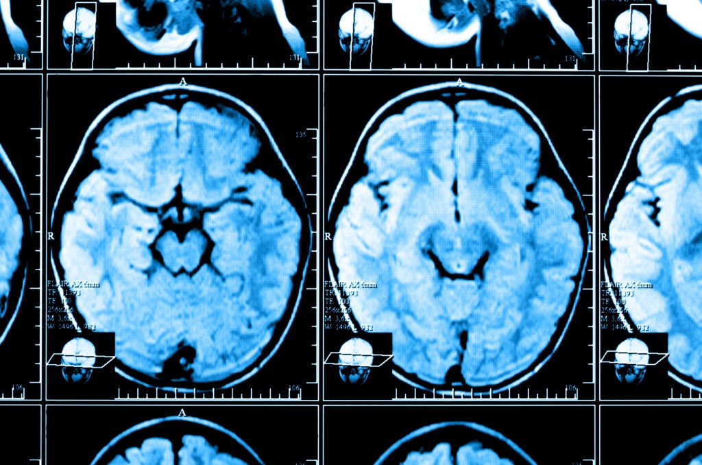 colorado brain injury lawyer